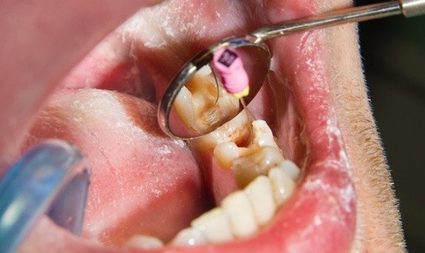 Răng sâu quá nặng sẽ phải lấy tủy