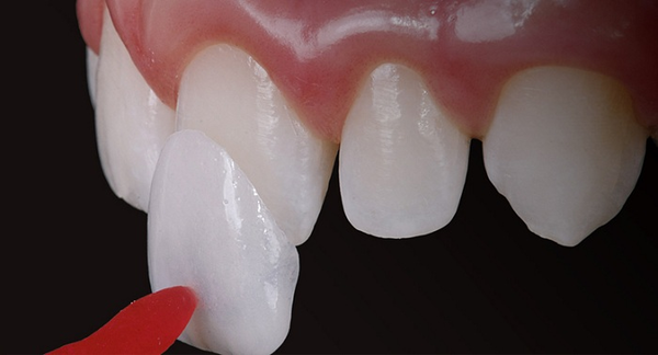 Mài răng nhiều hay ít tùy thuộc vào phương pháp bọc sứ bạn chọn