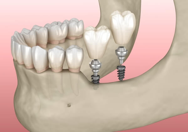 Bạn có thể lựa chọn Emedic Dental để được cắm trụ Implant an toàn