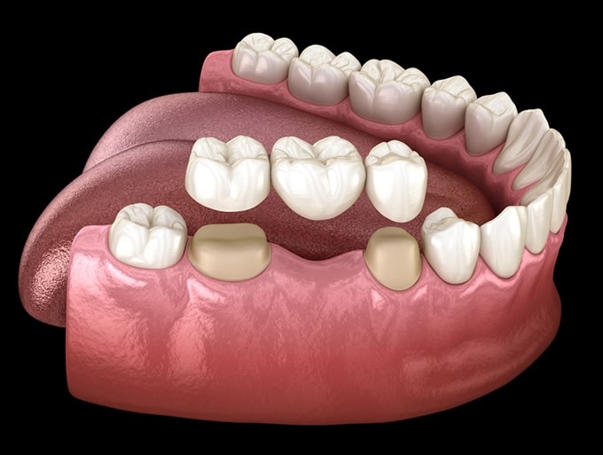 Khi bạn chọn trồng răng bằng cầu răng, nha sĩ sẽ làm việc chặt chẽ để tạo ra một bộ răng giả tương tự như răng tự nhiên của bạn