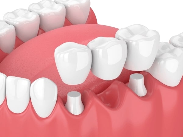 Cầu răng là một phương pháp thay thế răng mất bằng cách tạo ra một bộ răng giả