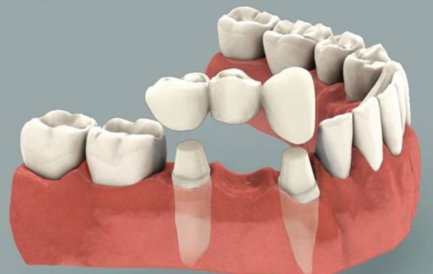Bên cạnh một số ưu điểm cầu răng cũng có những nhược điểm cần lưu ý 