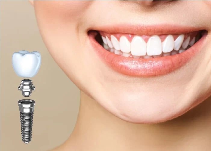 Cấy ghép implant là một phương pháp nha khoa tiên tiến để thay thế răng mất