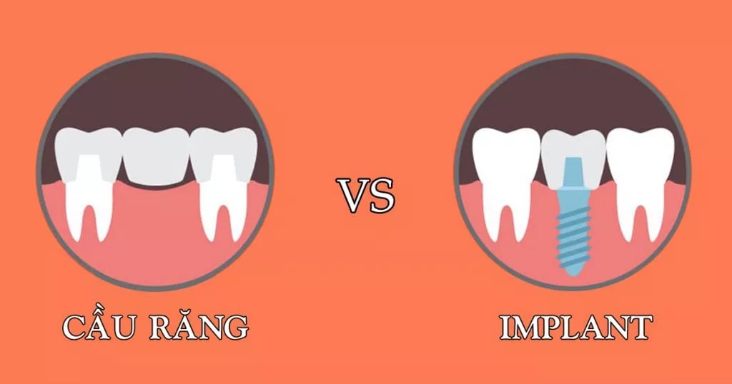 So sánh cầu răng sứ và trồng răng implant là một cách để hiểu rõ hơn về hai phương pháp này 