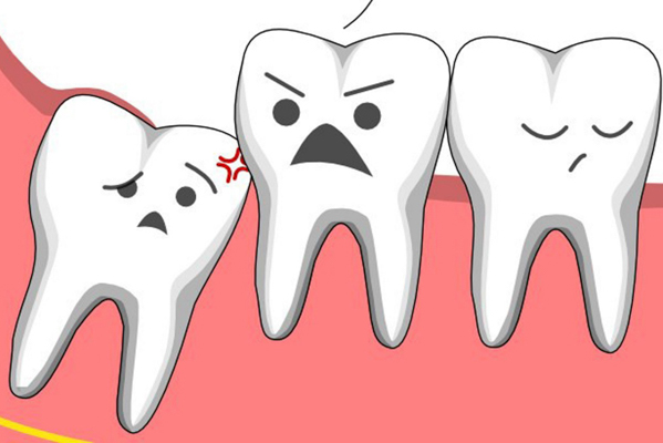 Răng khôn thường mọc sau khi xương hàm ngừng phát triển