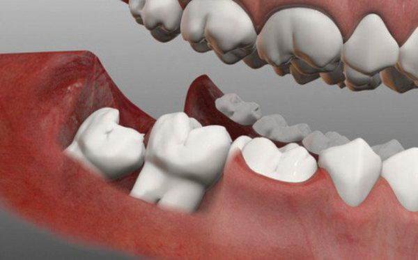 Răng khôn ít ảnh hưởng đến thẩm mỹ và chức năng nhai