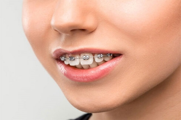 So sánh giữa niềng răng 1 hàm và niềng răng toàn hàm