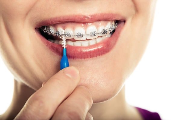 Lưu ý vệ sinh răng miệng cẩn thận khi niềng răng 1 hàm