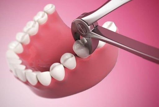 Số lượng răng phải nhổ khi niềng răng phụ thuộc vào nhiều nguyên do