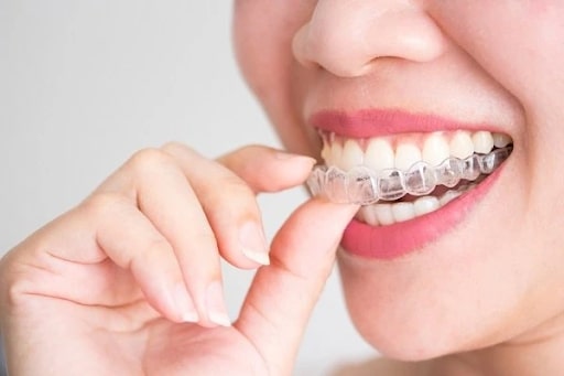 Niềng răng trong suốt là một trường hợp không đòi hỏi việc nhổ răng