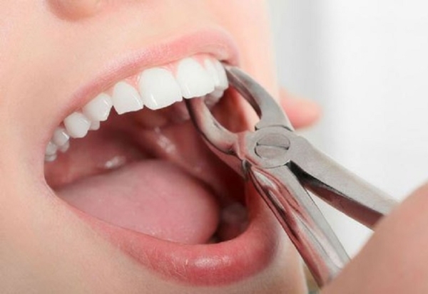 Niềng răng có phải nhổ răng không?