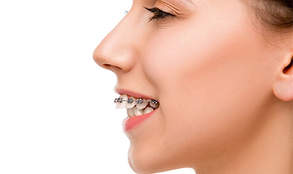 Khi phát hiện hàm hô thì bạn nên tiến hành niềng răng sớm