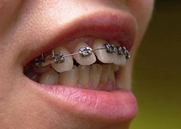 Hiện nay có nhiều phương pháp niềng răng hô phù hợp cho bạn