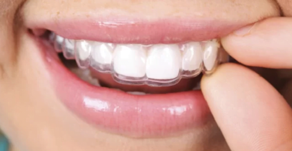 Lựa chọn loại niềng răng invisalign phù hợp với bản thân