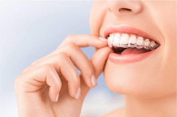 Hầu hết mọi người đều có thể sử dụng phương pháp niềng răng Invisalign