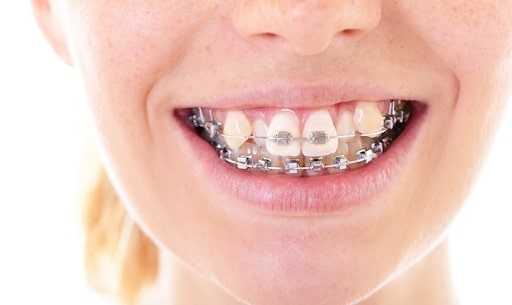 Niềng răng khểnh đã trở thành một giải pháp phổ biến