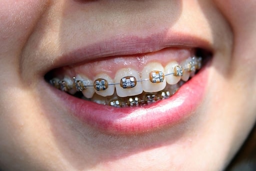 "Niềng răng không thành công" là một vấn đề quan trọng trong lĩnh vực nha khoa
