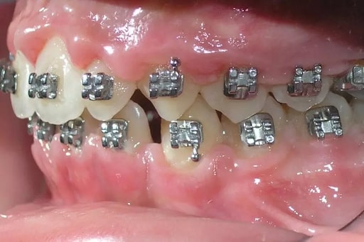 Có nhiều dấu hiệu nhận biết niềng răng không thành công