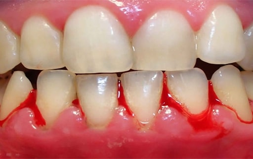 Nhiễm trùng nướu là một trong những vấn đề phổ biến trong việc niềng răng