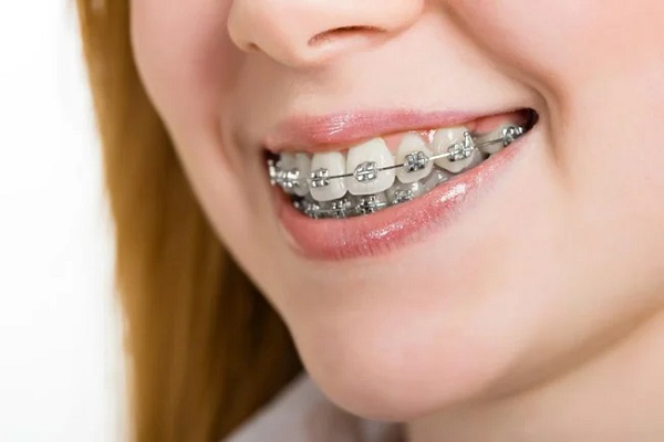 Niềng răng mắc cài kim loại là phương pháp truyền thống