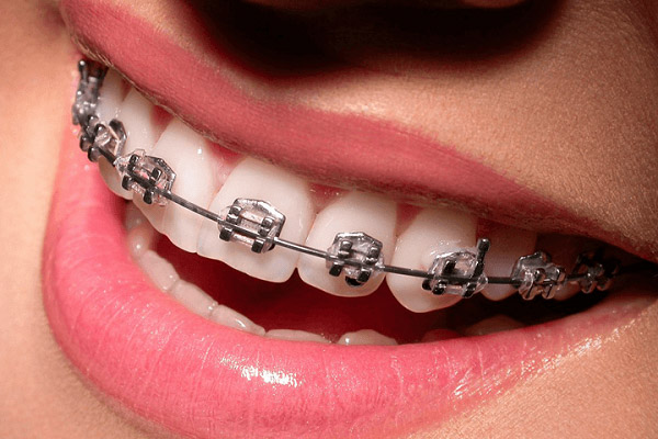 Các trường hợp răng mọc không đẹp, không đều thì nên niềng răng