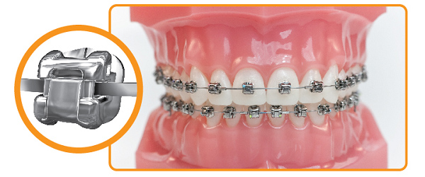 Chi phí niềng răng mắc cài kim loại phụ thuộc vào nhiều yếu tố