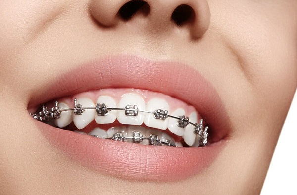 Niềng răng mắc cài sắt là phương pháp truyền thống
