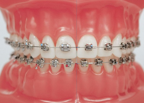 Niềng răng sắt mang nhiều đặc điểm khá nổi bật