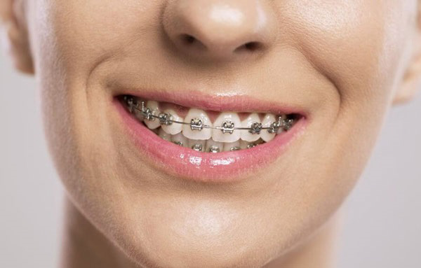 Thời gian niềng răng sắt phụ thuộc vào nhiều yếu tố