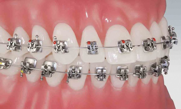 Lưu ý để niềng răng được đảm bảo hiệu quả tốt nhất