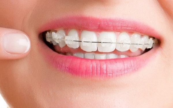 Tuân thủ những lưu ý quan trọng khi niềng răng để đảm bảo kết quả tốt nhất