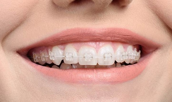 Tìm hiểu phương pháp niềng răng mắc cài sứ