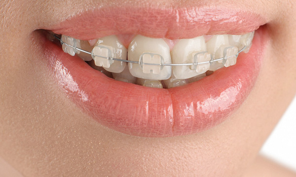 Niềng răng mắc cài sứ mang nhiều ưu điểm vượt trội