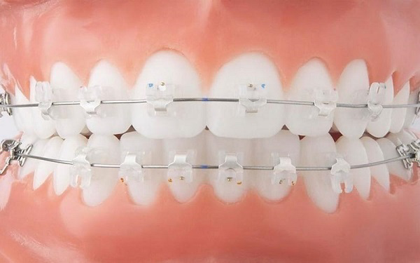 Quy trình niềng răng mắc cài sứ tại Emedic Dental