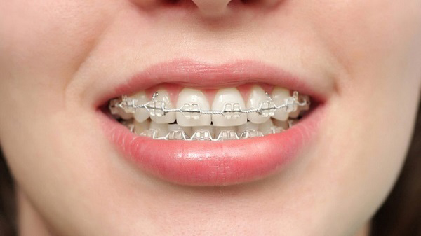 Niềng răng mất bao lâu? Thời gian niềng răng giữa trẻ em và người lớn sẽ chênh lệch nhau khá nhiều