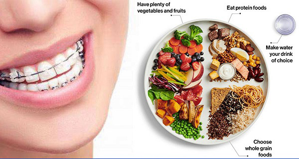 Thói quen ăn uống ảnh hưởng đến niềng răng thế nào? Niềng răng nên ăn gì?