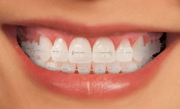 Thời gian niềng pha lê phụ thuộc nhiều vào tình trạng răng của bạn