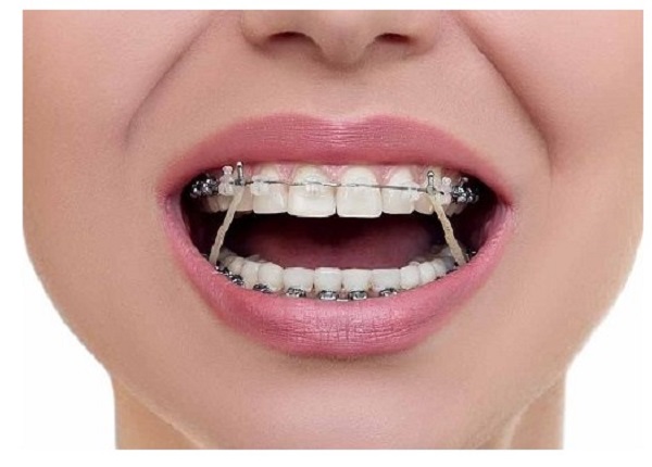 Phương pháp niềng răng khác nhau sẽ có mức giá khác nhau