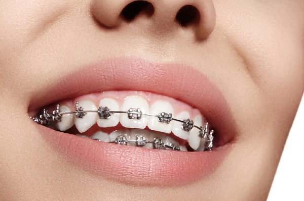 Niềng răng mắc cài kim loại đang là phương pháp niềng răng rẻ nhất
