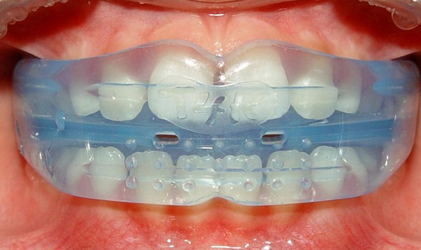 Niềng răng tại nhà có thể để lại nhiều hậu quả nghiêm trọng