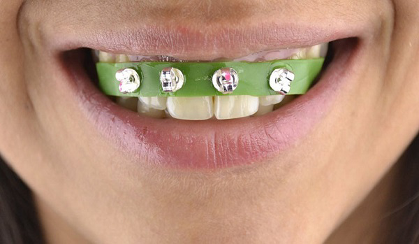 Không nên tự chế niềng răng tại nhà nếu không thể đảm bảo kỹ thuật