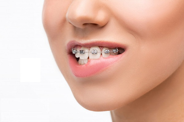 Răng thưa có thể gây nên nhiều tác hại nên được điều trị sớm