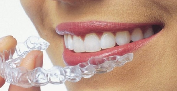 Niềng răng trong suốt mang nhiều ưu điểm vượt bậc