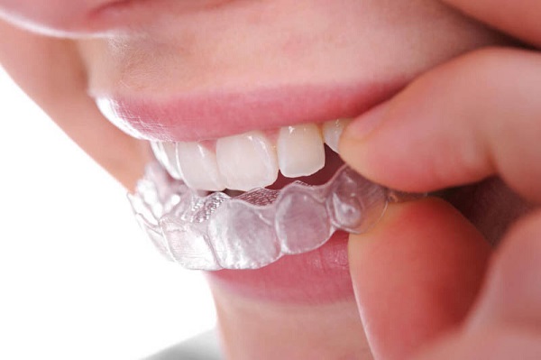 Niềng răng trong suốt có đau không là vấn đề nhiều người quan tâm