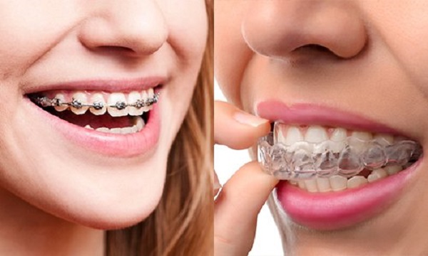 So với niềng răng mắc cài thì niềng răng trong suốt có nhiều ưu điểm hơn