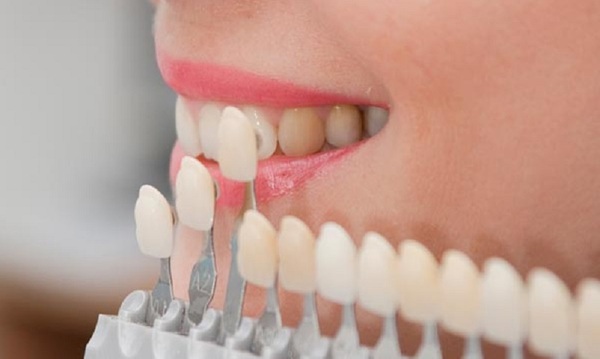 Giới thiệu quy trình bọc răng sứ đúng cách