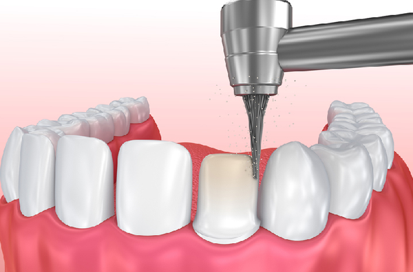 Quy trình bọc răng sứ chính xác cần phải trải qua 9 bước