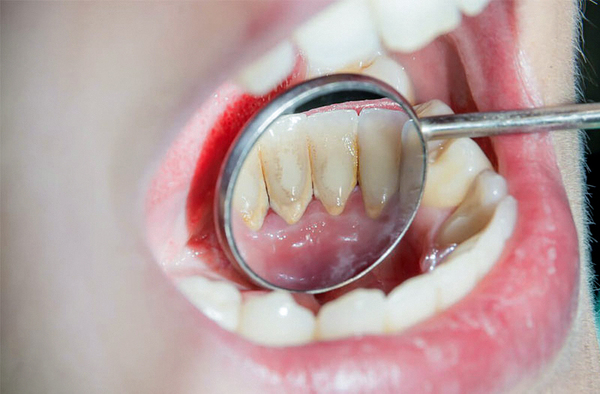 Trước khi làm răng sứ thì bác sĩ sẽ vệ sinh răng miệng của bạn
