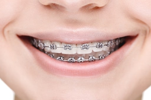 Niềng răng là một quá trình chăm sóc và chỉnh hình hàm răng để mang lại nụ cười hoàn hảo