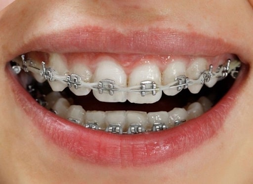 Niềng răng mắc cài kim loại là phương pháp niềng răng truyền thống